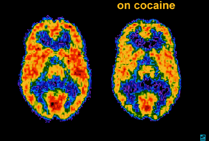 bộ não cocaine